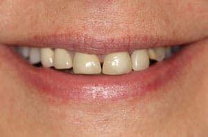 Cosmetic Dentistry 1 Before