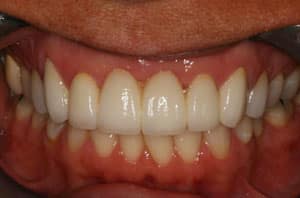 cosmetic dentistry 3 after