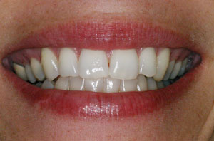teeth whitening1 after