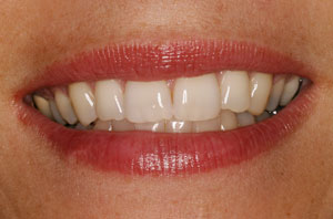 teeth whitening1 before
