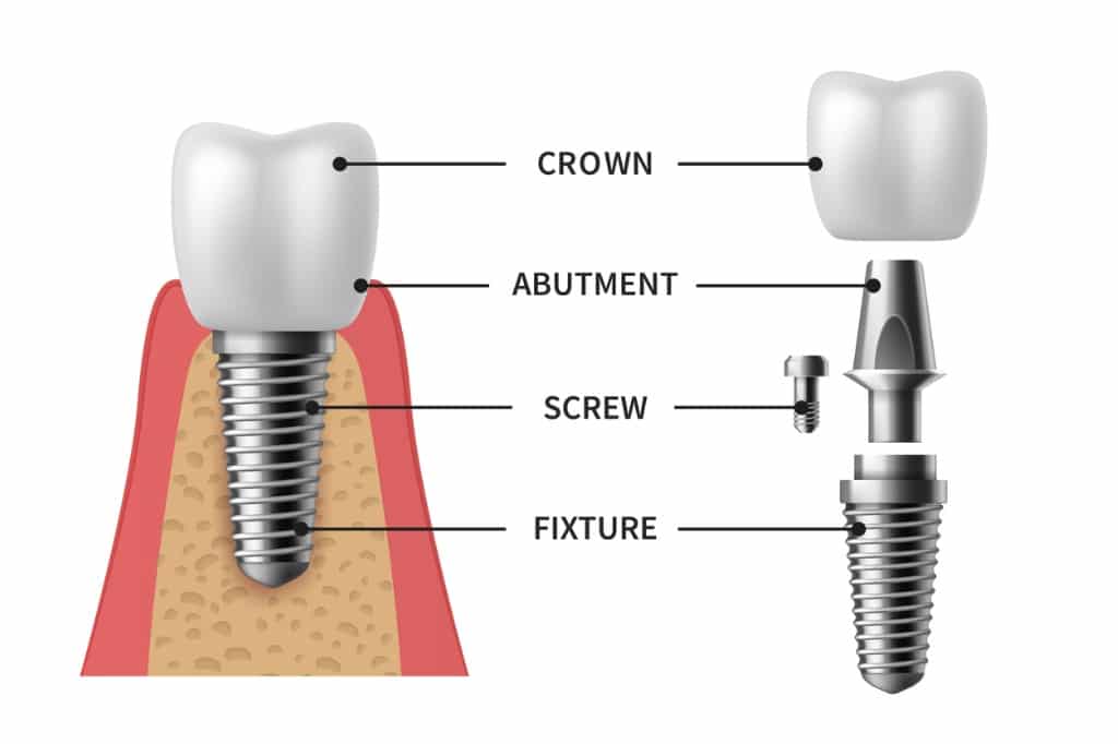 tooth implant realistic implant structure pictorial models crown abutment screw denture.jpg s1024x1024wisk20c5waMmO2T6a4MWkCd5AgQu5YUg6MVY2L1ohHqGZYnrFE