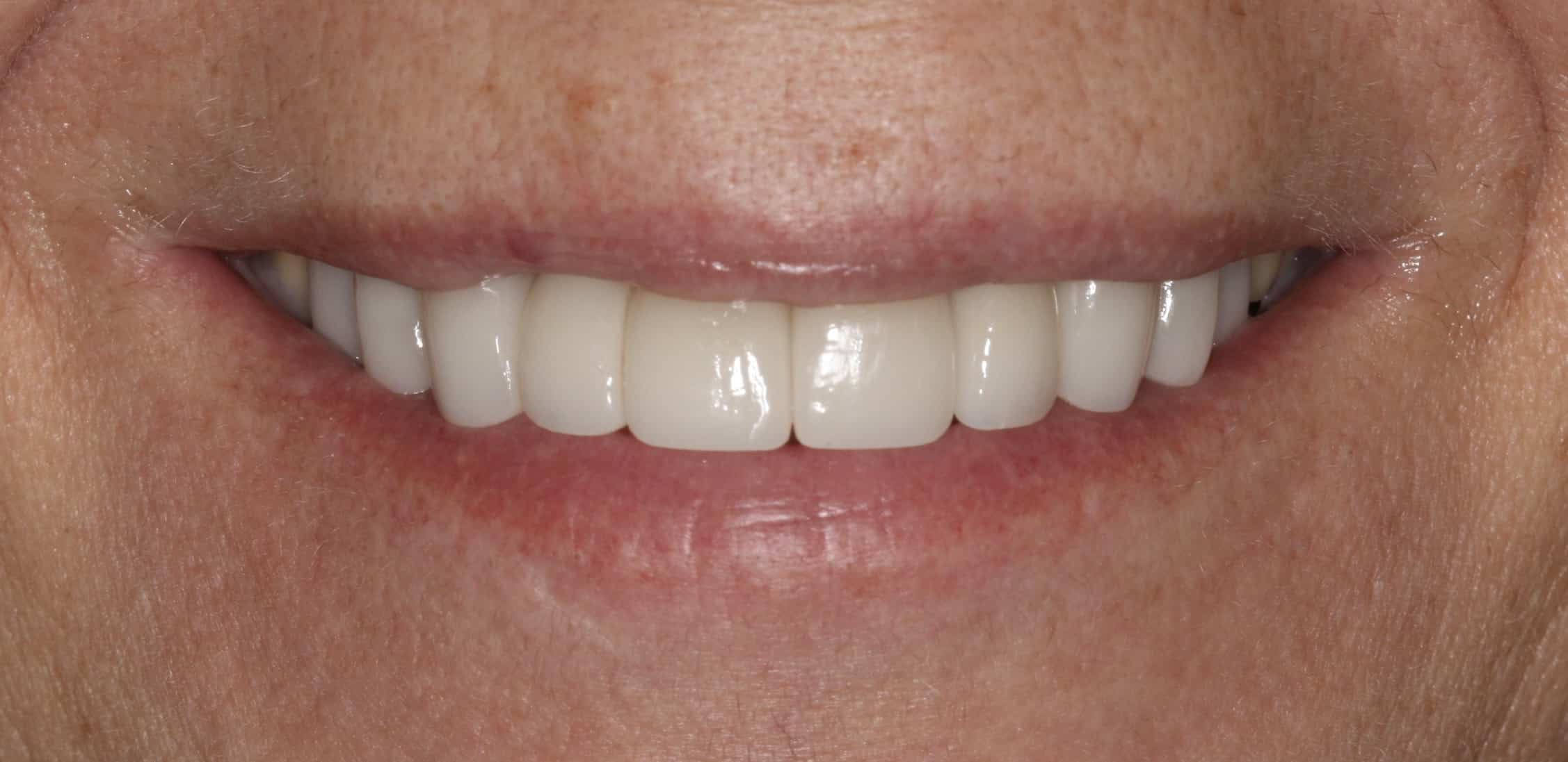 Porcelain Veneers