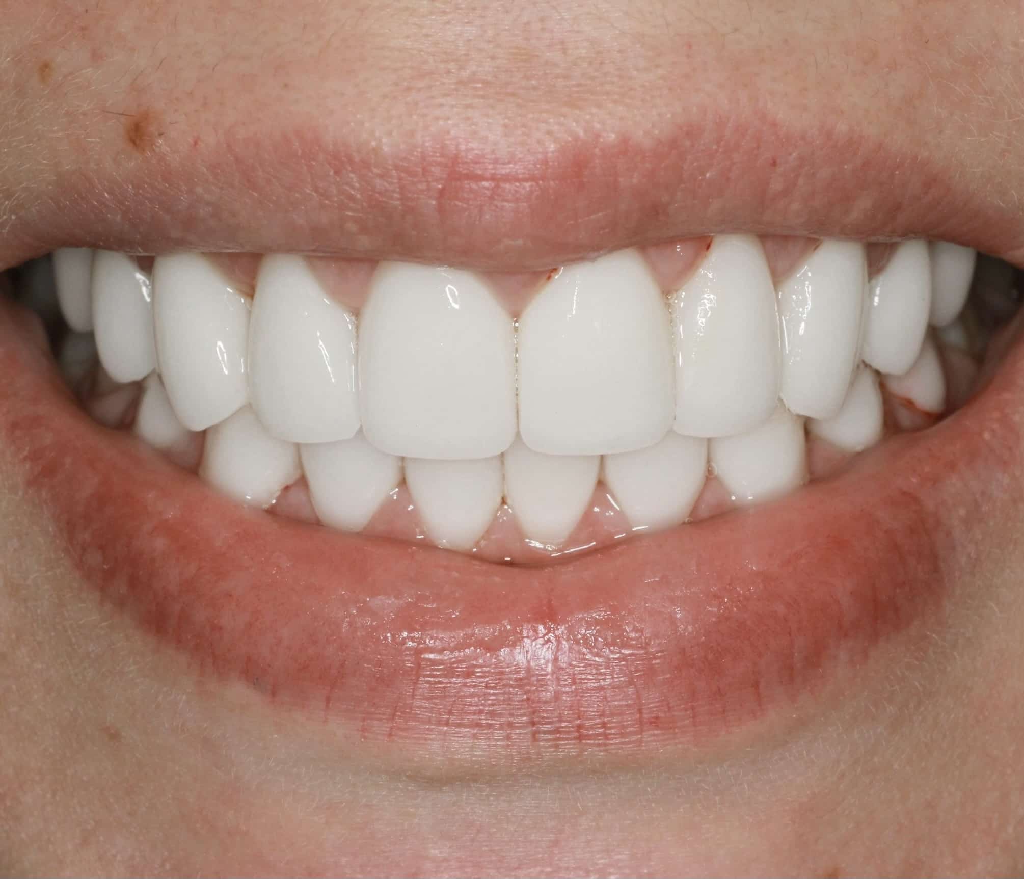 Porcelain Veneers