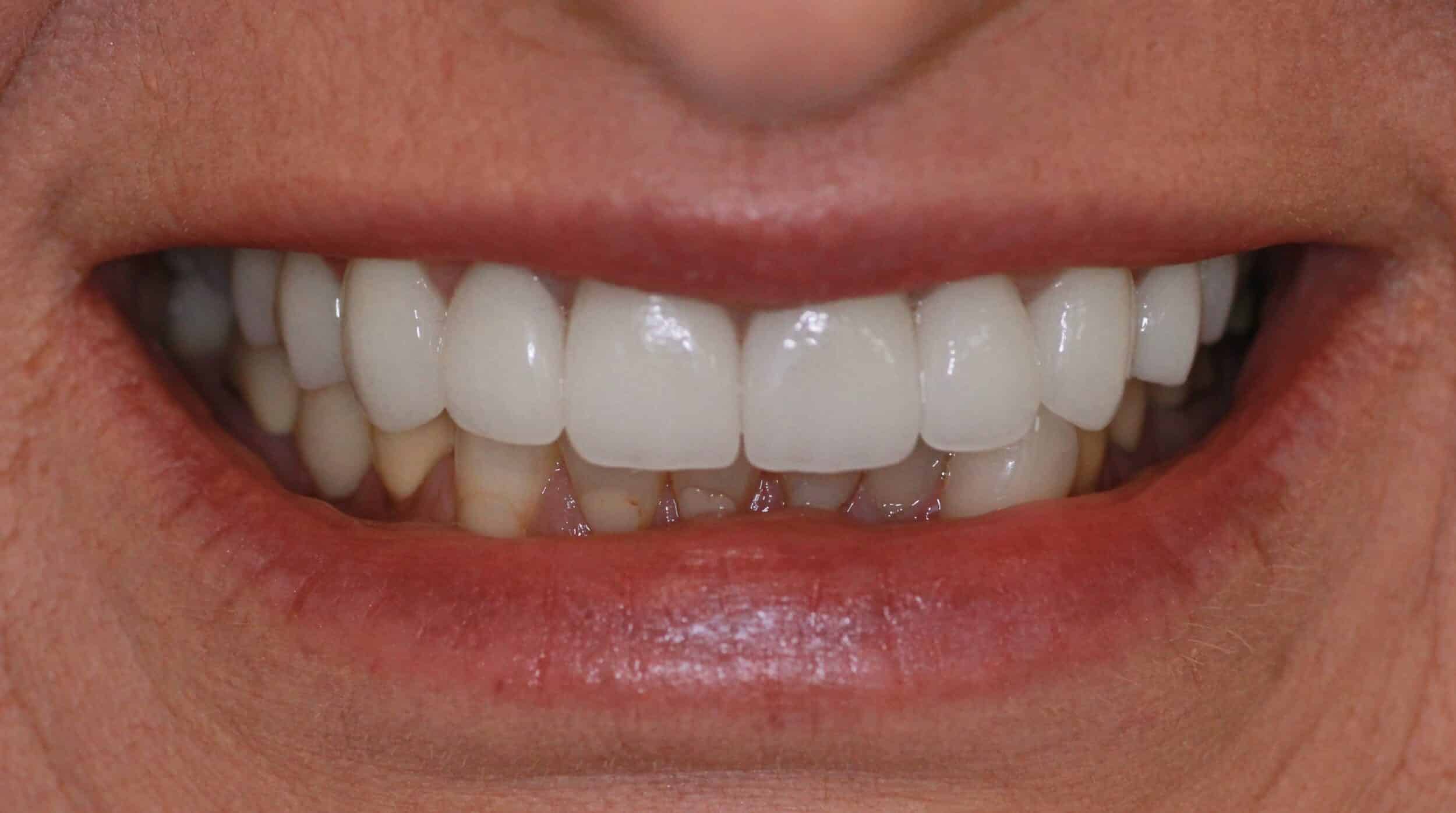 Porcelain Veneers