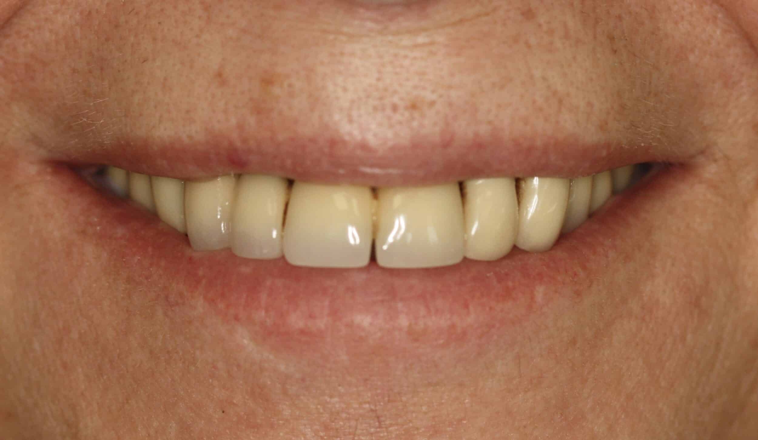 Porcelain Veneers