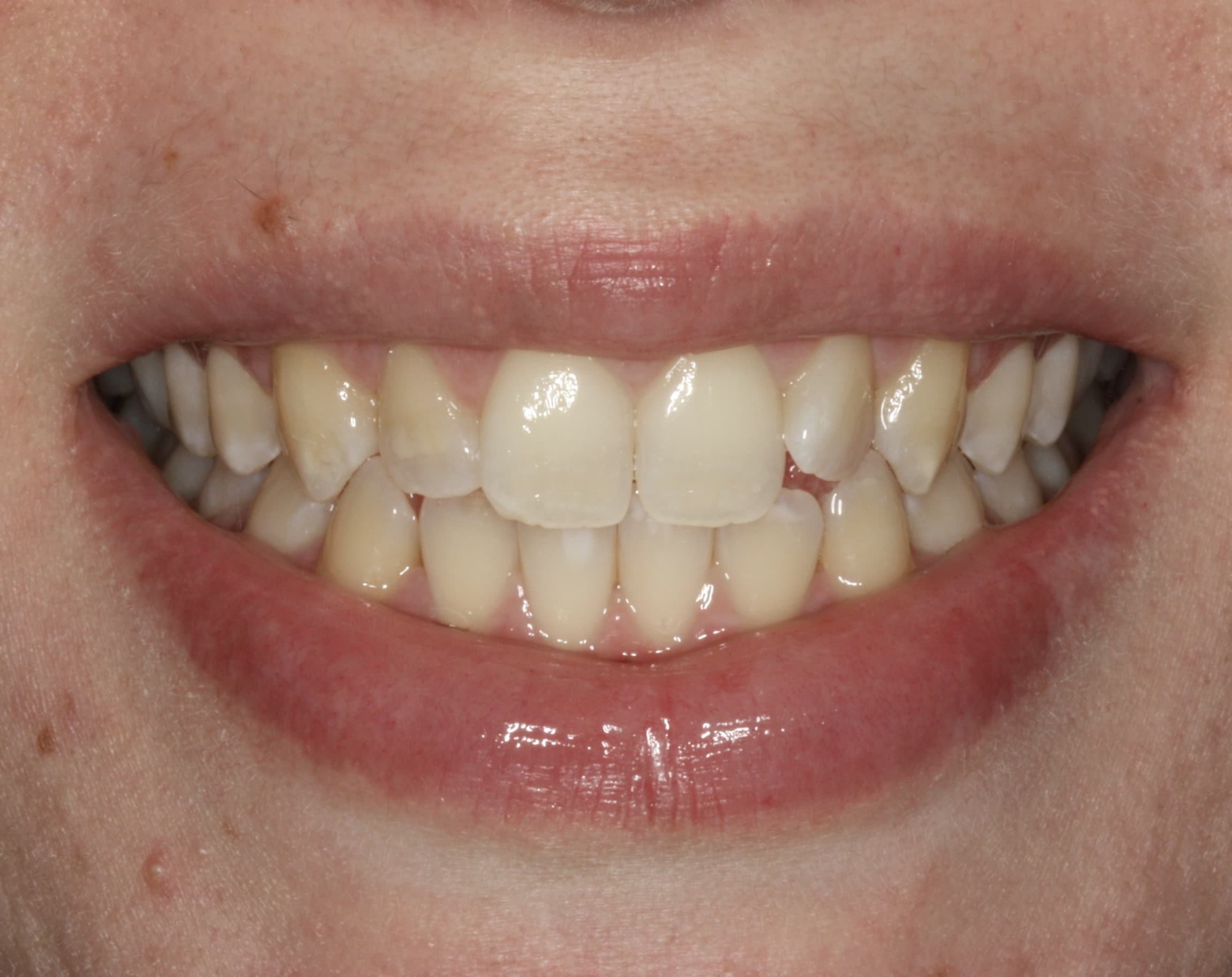 Porcelain Veneers