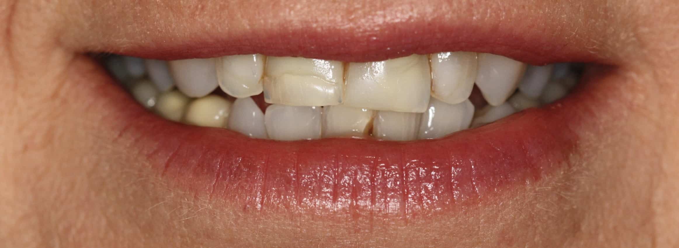 Porcelain Veneers